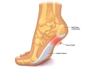 plantar fasciitis